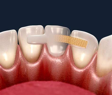 maryland bridge tooth replacement